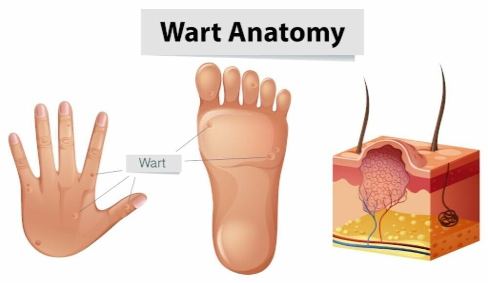 Successful removal of warts with root using Removio