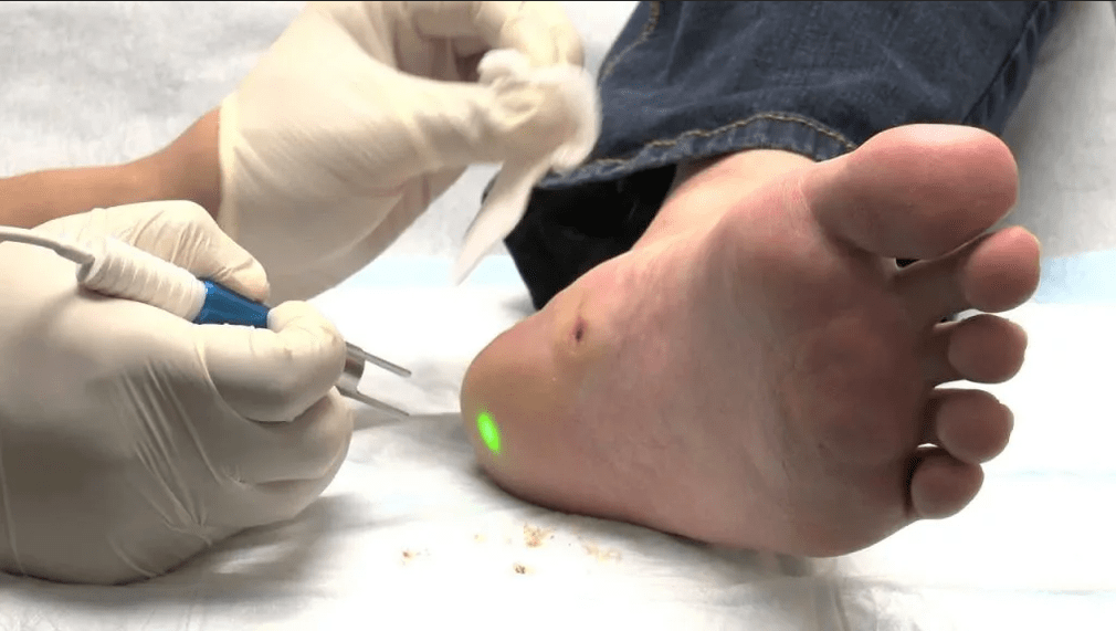PLANTAR WARTIN TREATMENT