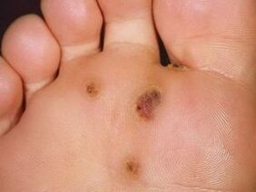 How to get rid of a plantar war