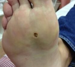 Ways to remove the wart of the war