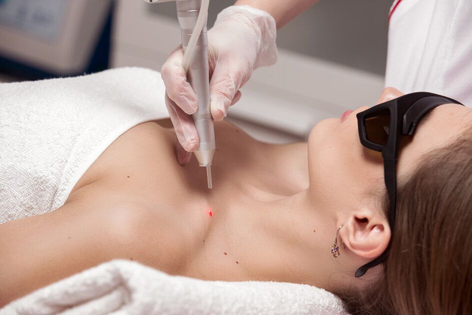 Laser withdrawal of papiles