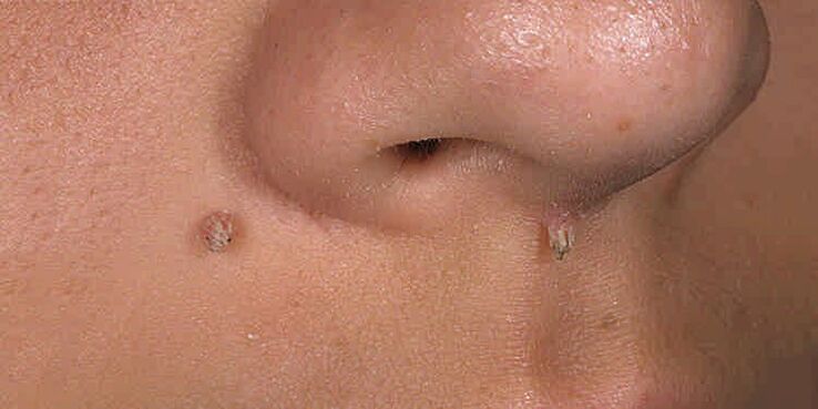 Causes of the appearance of papilloms