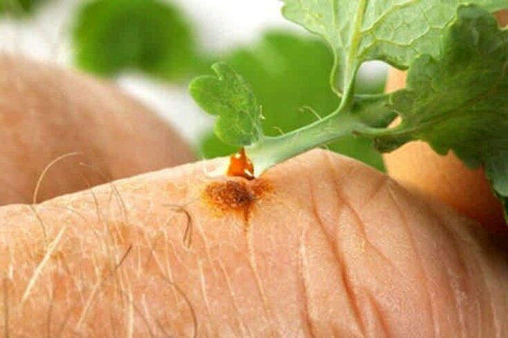 How to remove papillomas with folk treatment