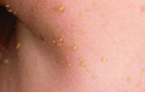 Reasons for the appearance of papiles in the body