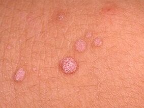 How to get rid of papiles in the body
