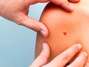 Reasons for the appearance of papiles in the body
