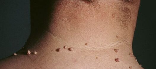 How to get rid of papillomas