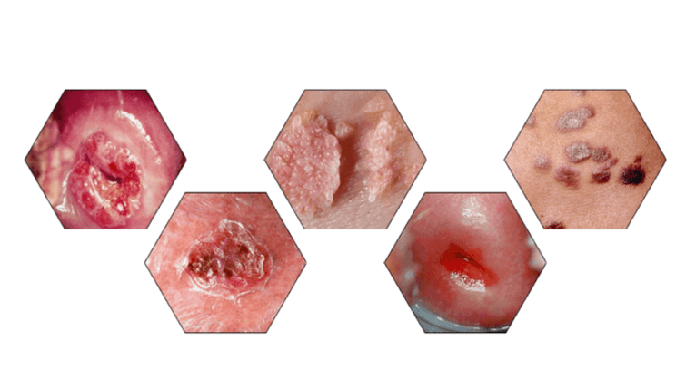 Why are papillomas dangerous