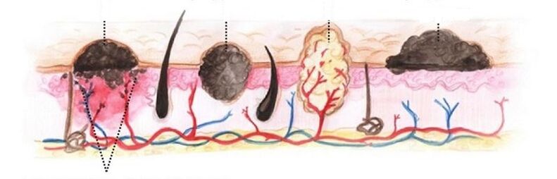types of papilloma in the human body
