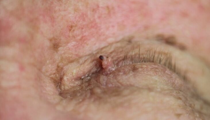 How to get rid of papilloma on the eyelid
