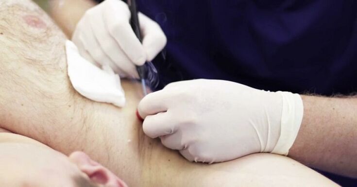 professional methods to eliminate papillomas on the human body