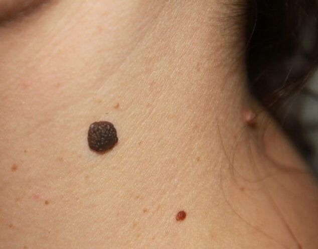 Flat papillomas on the neck