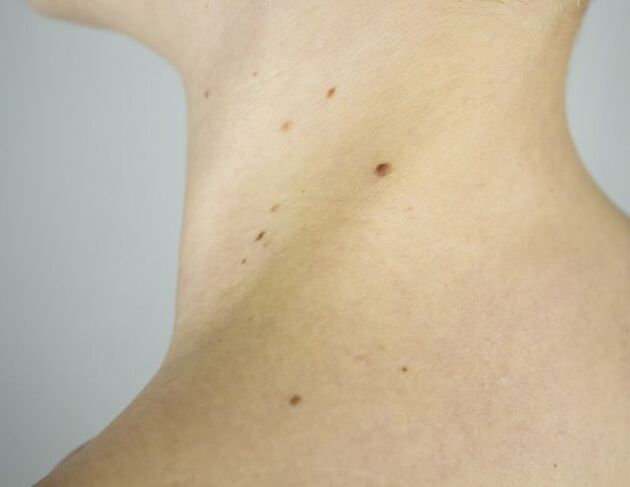 Papillomas on the girl's neck