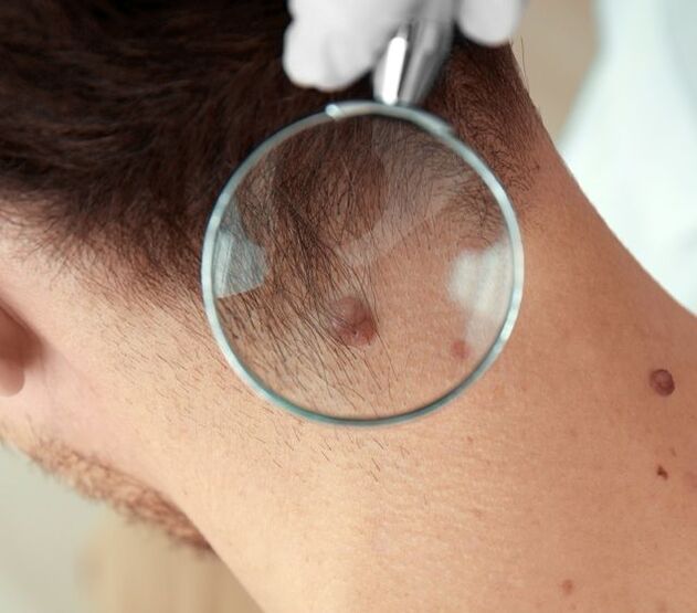 The doctor examines a papilloma on the neck
