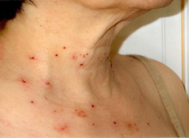 The results of the treatment of papillomas on the neck
