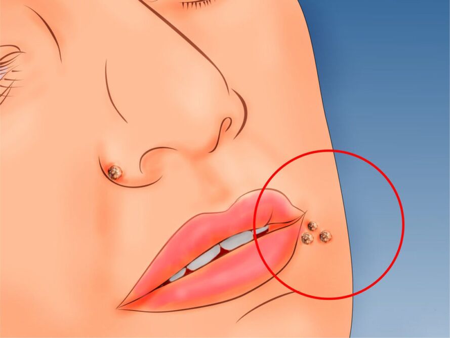 Papillomas on the face