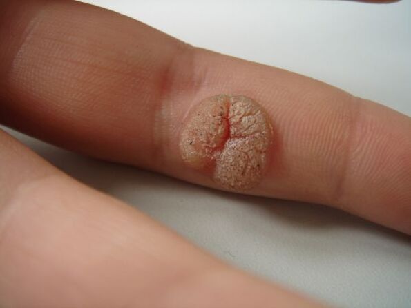 The complexity of self-removal of papillomas