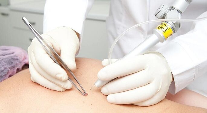 laser removal of papillomas for papillomavirus