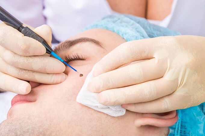 removal of papillomas on the face due to human papillomavirus