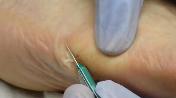 Surgical removal of plant warts