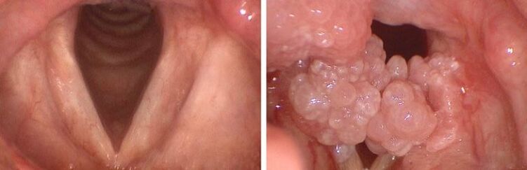 clear papillomas in the throat and pharynx